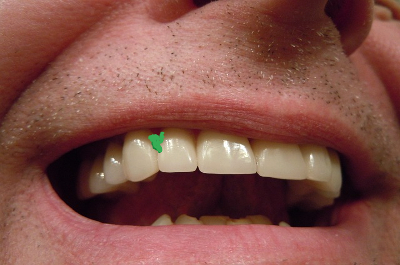 Is There Lettuce in Your Teeth?